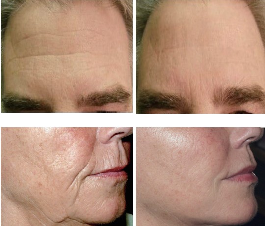 Bi-polar/mono Polar Microneedle RF Fractional Machine