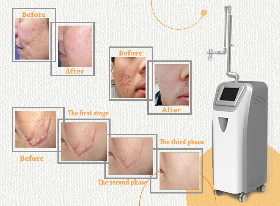 Co2 Laser Skin And Face Lifting System
