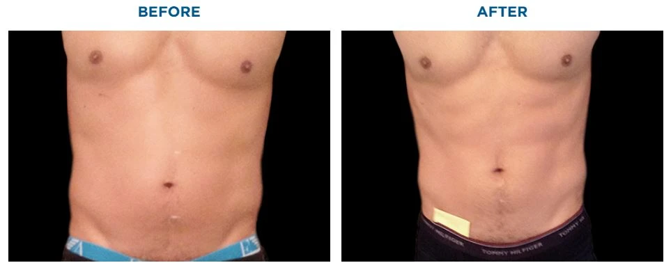Emsculpt Build Muscle machine